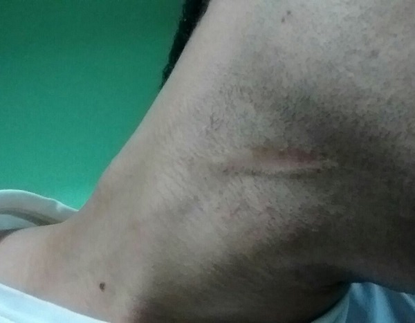 Cicatriz no pescoço de Lucas . (Foto do arquivo pessoal)